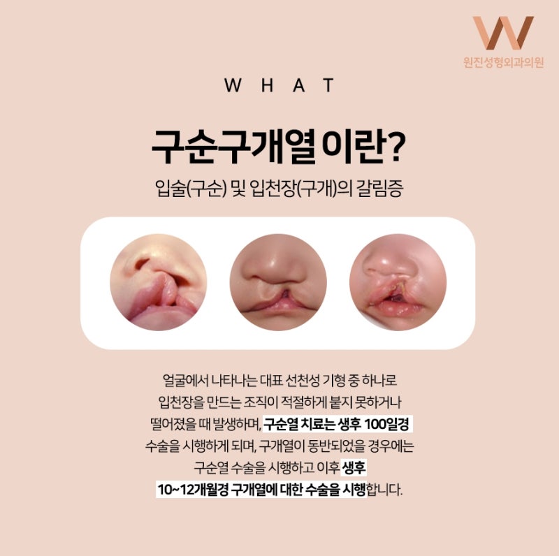 구순열 치료 및 인식에 대한 지속적인 필요성