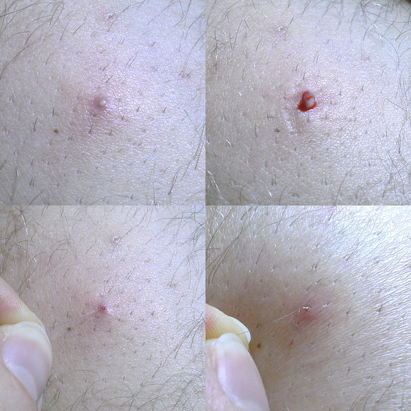  평택왁싱 "더제이"  인그로운헤어 (Ingrown Hair) / 발생이유 / 관리 방법