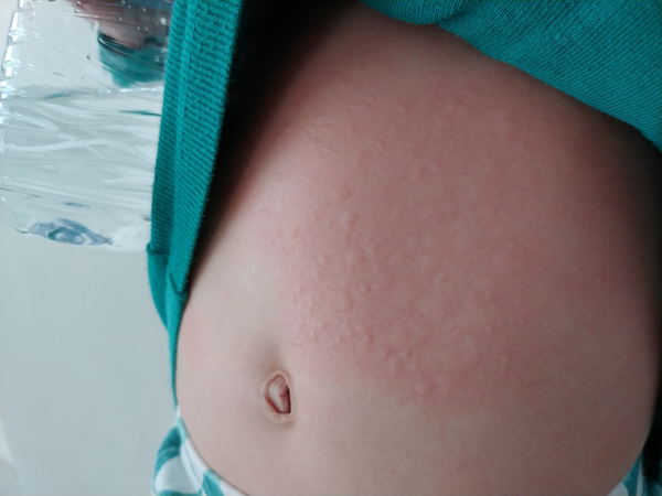 3세 아기 온몸에 급성 두드러기, 가려움 증상(원인모를 음식 알레르기, 알레르기검사MAST)