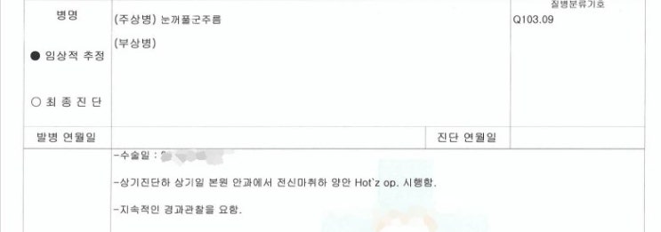 속눈썹이 눈을 자꾸 찌르는 아이, 태아보험 선천이상수술비 청구하기 속눈썹이 눈을 자꾸 찌르는 아이, 태아보험 선천이상수술비 청구하기