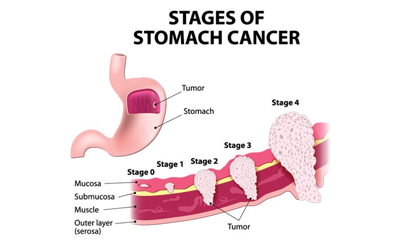 조기 위암의 정의와 분류(Early Gastric Cancer: An Overview and classification ...
