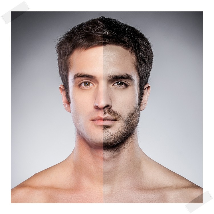 [인천 남성 수염 레이저 제모 가격/청라 남성 수염 제모] 턱수염 인중 제모