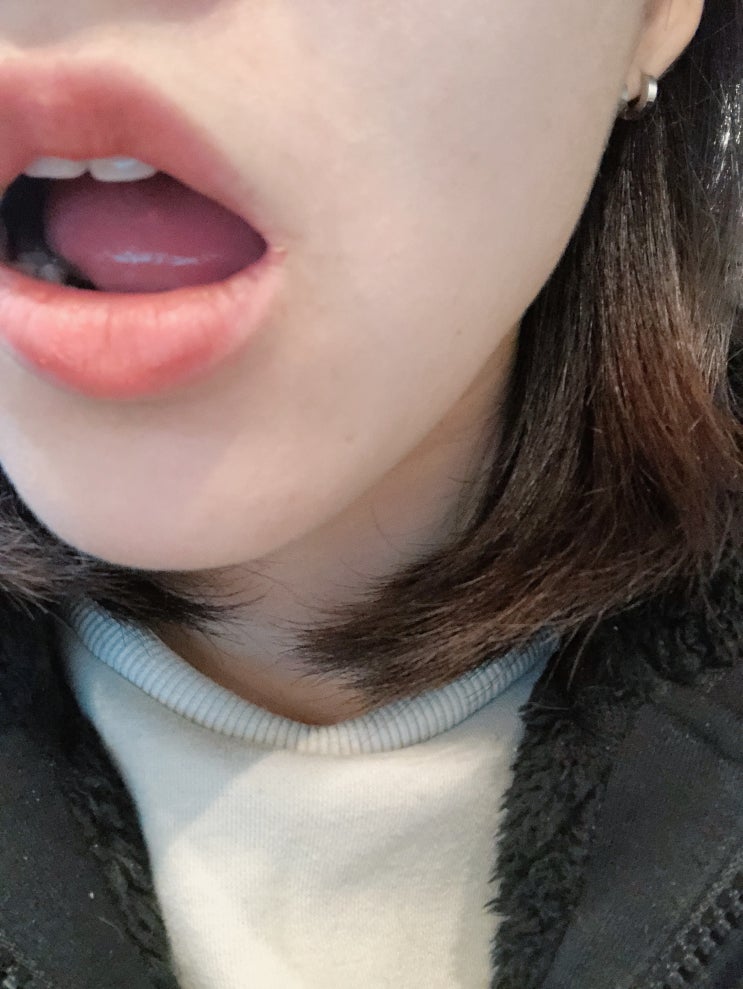  입옆찢어짐 피곤함으로 고생중...!
