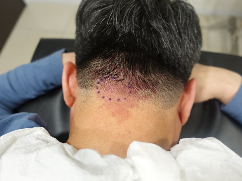 [Dr.ParK] 등 깊숙한 곳에서 혹이 만져집니다. 근막에 둘러싸인 지방종 제거 수술 5