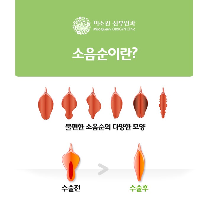 [마포구 산부인과] 소음순 늘어남 개선 수술로 아름답게