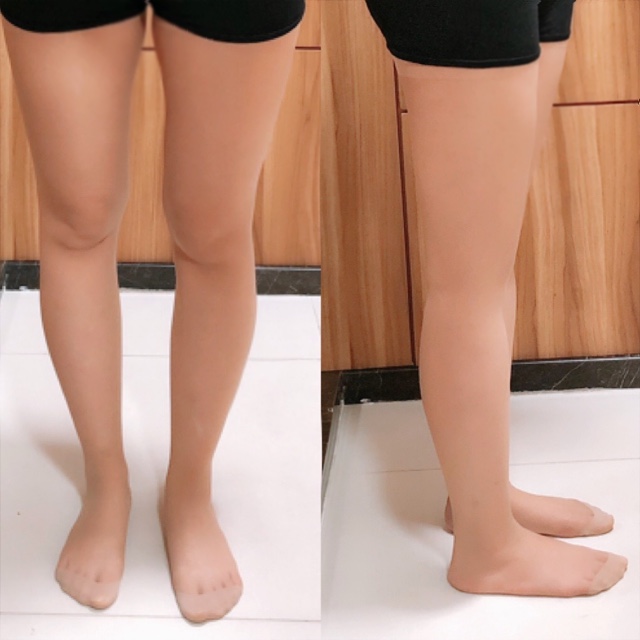  지방분해주사 걸그룹주사 대망의 5회차 후기