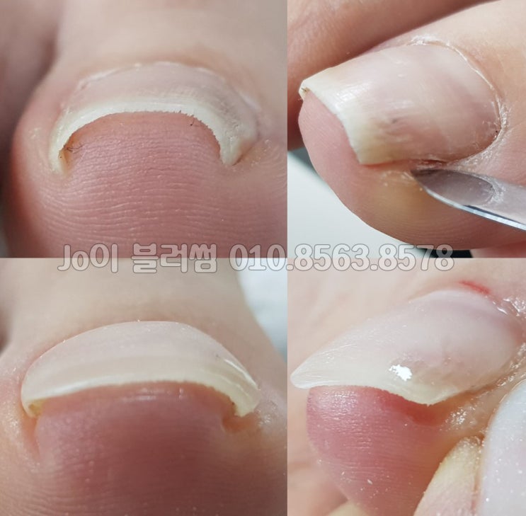  용인네일샵 파고드는발톱 전문관리 네일샵으로 발톱에 관한 즐겁고 행복한 이야기 조이블러썸