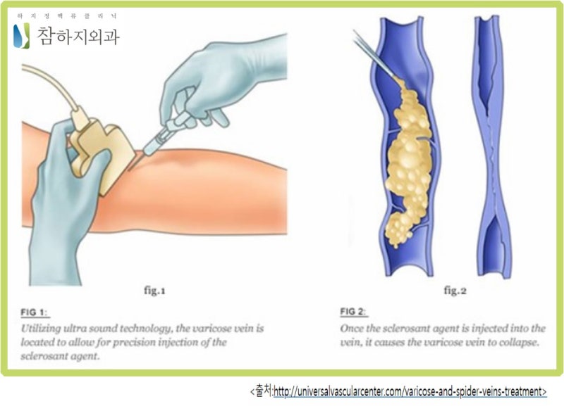 혈관경화요법이 가는 혈관의 경우 적용