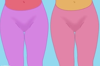 Y존 부각 & 치골 돌출 원인과 해결 방법 -2 : 네이버 블로그 Y존 부각 & 치골 돌출 원인과 해결 방법 -2 : 네이버 블로그