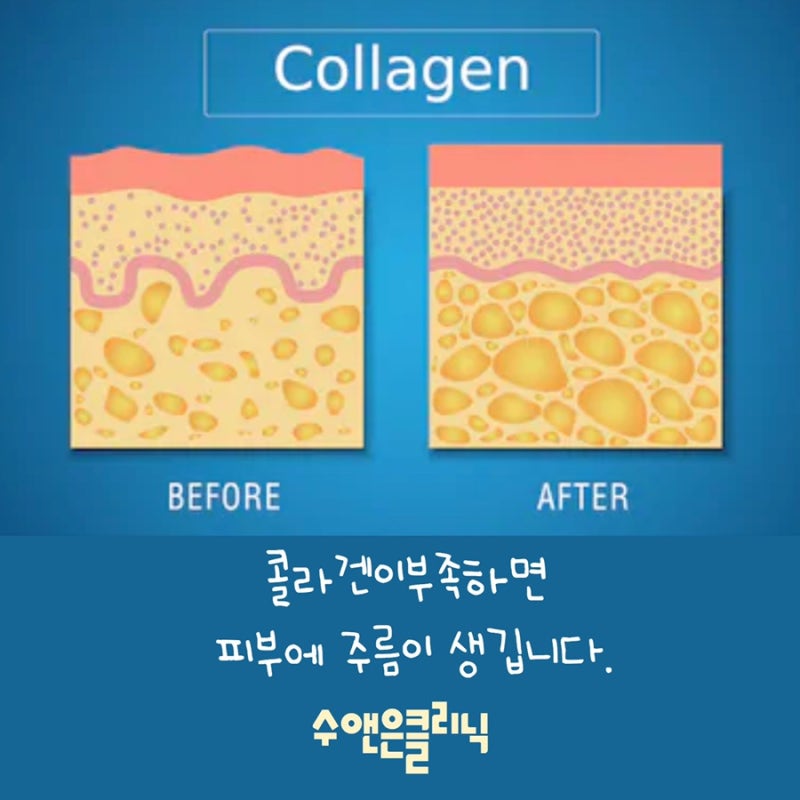 실 리프팅 부작용 없는 청담피부과 5G 리프팅 유스피로 옆볼 필러, 볼해소 (팔자주름수술X)