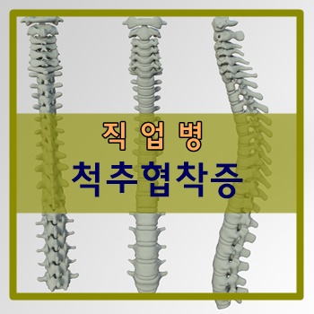  직업병, 척추 협착증