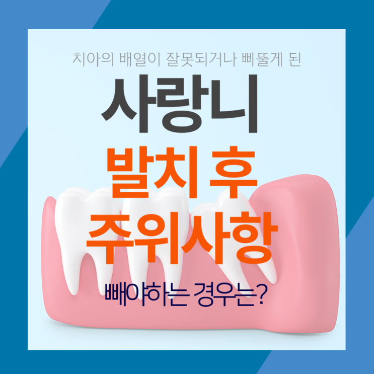  사랑니 발치후 주의사항! 빼야되는경우?!