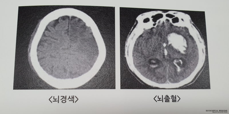 뇌졸중 뇌출혈 뇌경색 재활치료 2