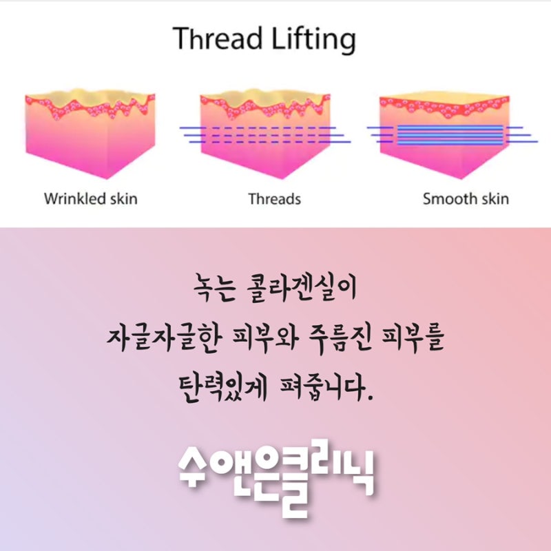 실 리프팅 부작용 없는 청담피부과 5G 리프팅 유스피로 옆볼 필러, 볼해소 (팔자주름수술X) 3