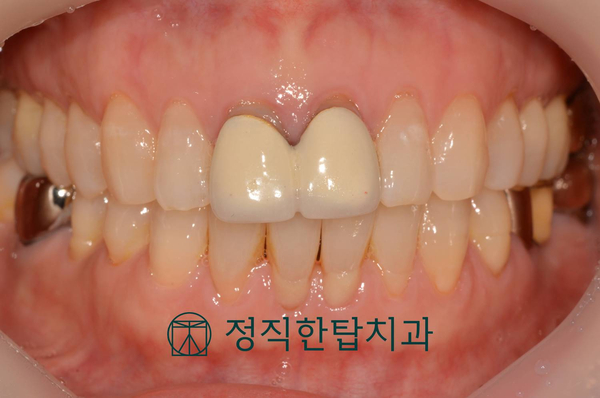 [정자역 치과]오래된 앞니 재치료, 자연스러운 미소를 되찾으세요