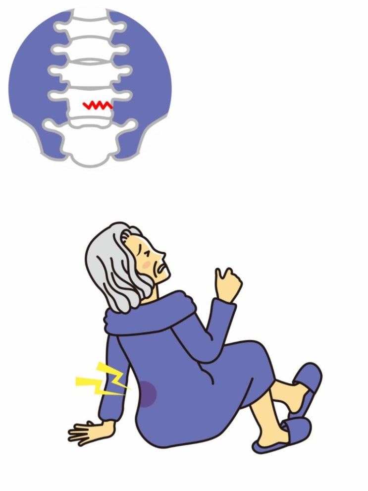  척추압박골절 후유장해진단서 주치의한테 받으세요!