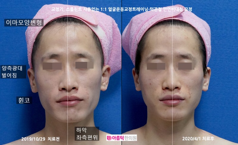 안면비대칭 교정, 턱관절 운동으로 얼굴형 바꾸기 : 네이버 블로그