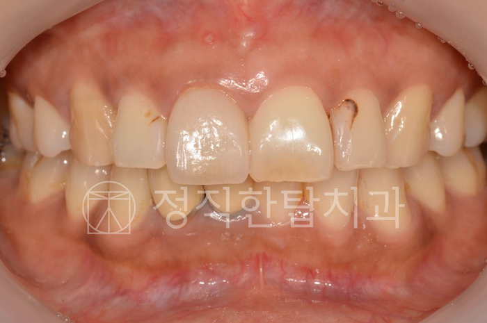  [정자동 치과] 앞니 레진 변색, 제거하지 않고 리터치한 경우