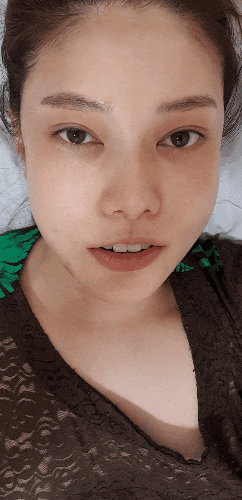  [리뷰볼래] 강남 압구정 포인트 성형외과에서 울쎄라, 보톡스, 리프팅, 윤곽주사 하기전과 후
