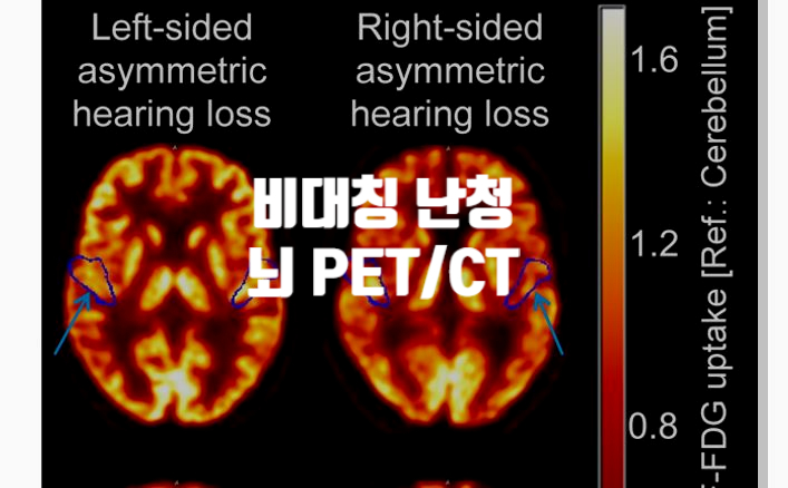 달팽이관 임플란트 효과 예측 고해상도 PET/CT 이미지