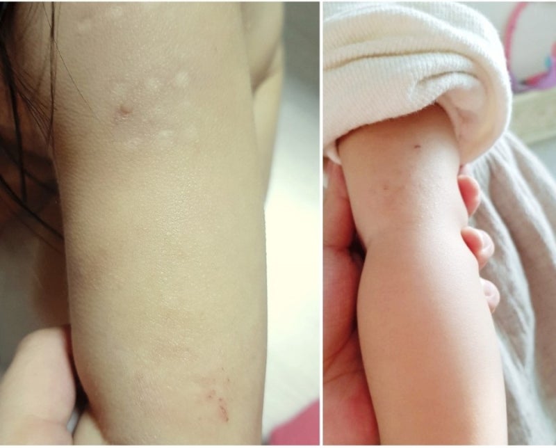 아기에게 알레르기 검사가 필요합니까?테스트 방법과 비용 알아보기