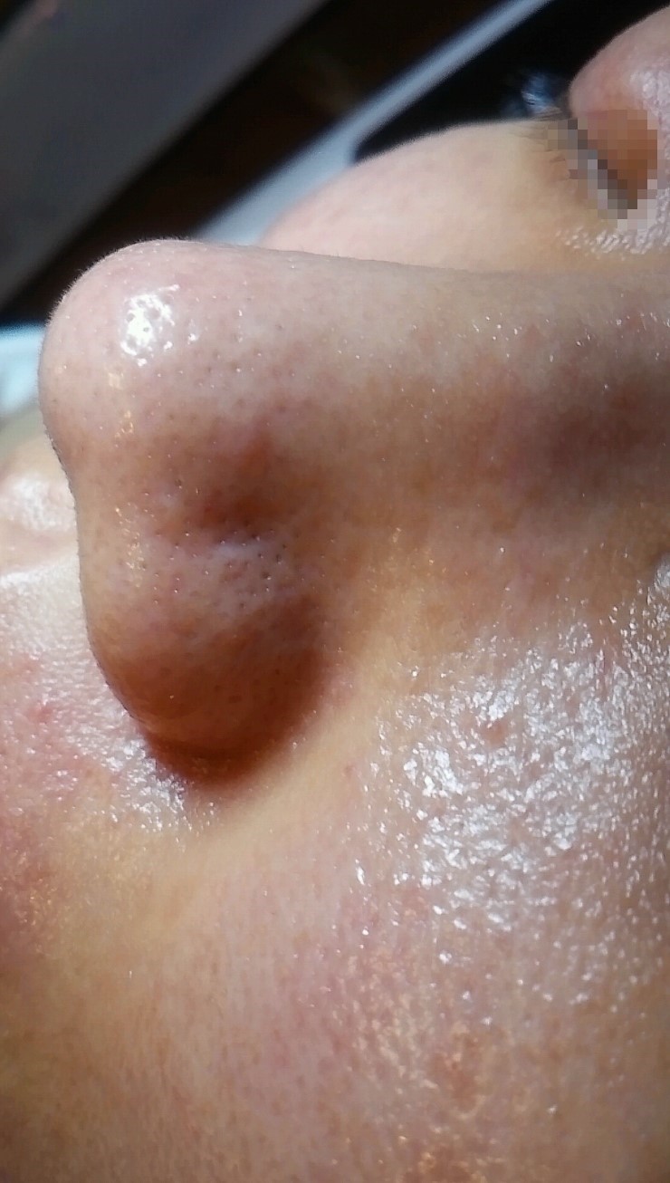  블랙헤드를 없애고 피부를 깨끗하게 만들자