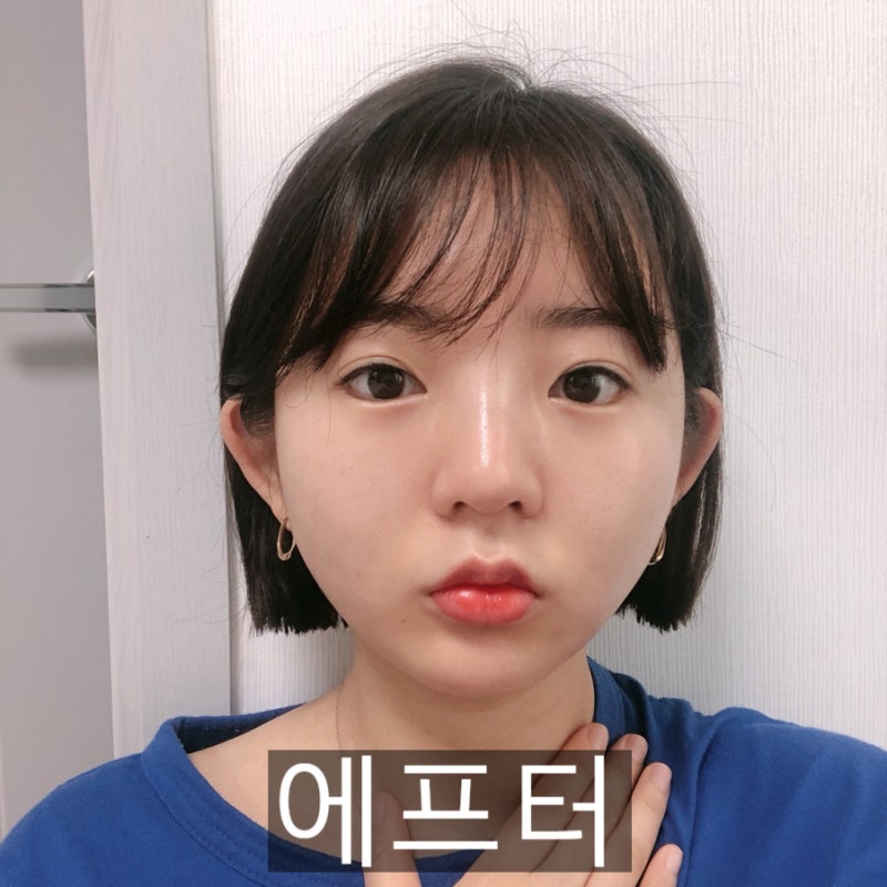 민트 실리프팅 비용