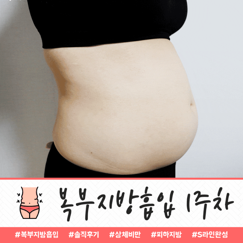 뱃살 지방흡입 가격 및 4개월 후기 (붓기, 통증, Q&A) 2