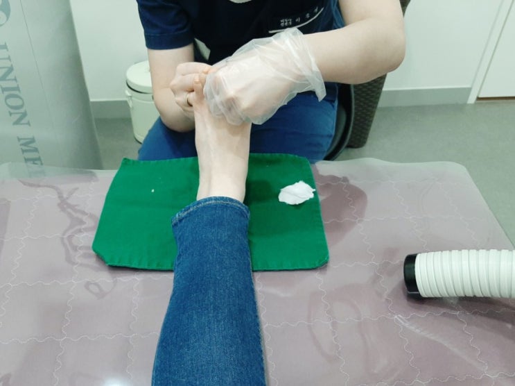  발바닥 티눈 제거 후기
