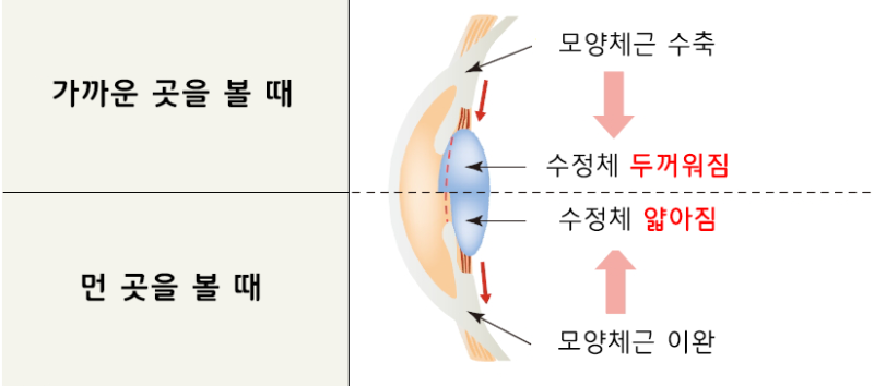 노안라식수술 노안수술잘하는곳 찾는다면 5