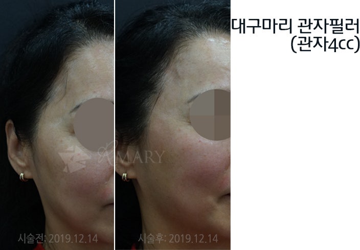 관자놀이가 꺼지는 이유! 대구마리의원 땅콩 필러, 옆볼꺼짐필러, 치아교정 후 볼 꺼짐 필러 : 네이버 블로그 관자놀이가 꺼지는 이유! 대구마리의원 땅콩 필러, 옆볼꺼짐필러, 치아교정 후 볼 꺼짐 필러 : 네이버 블로그