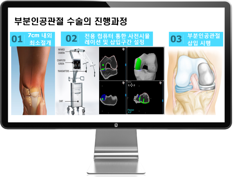 무릎인공관절 수술 색전증, 기능제한 걱정 없는 부분치환술(UKR) : 네이버 블로그