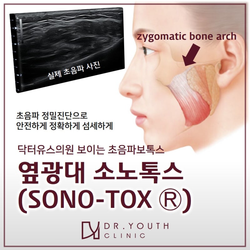 옆 광대 줄이는 법 2: 보톡스? 윤곽 주사? 2