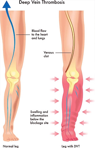  임신 중 DVT(심부정맥혈전증)