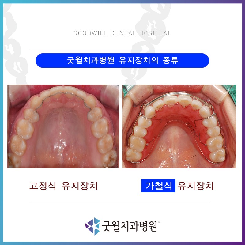 치아교정] 가철식 유지장치의 장착방법 과 주의사항 : 네이버 블로그
