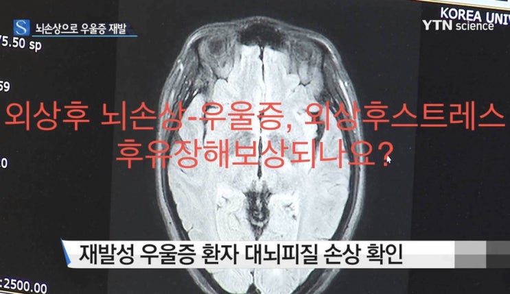  두부외상후 우울증, 외상후스트레스장애- 후유장해 보상 가능할까요?