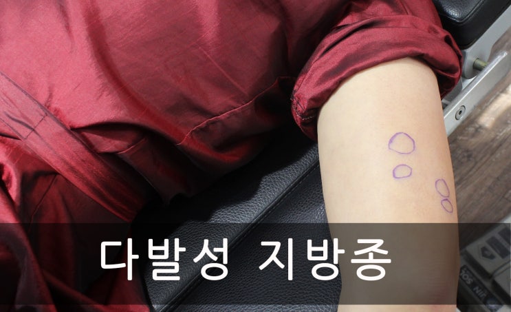  팔에 발생한 다발성 지방종 제거수술