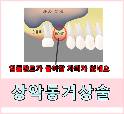 임플란트상악동거상술이란?