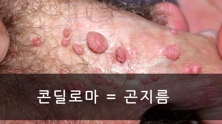  콘딜로마 '발생 원인은 HPV 증상은 다양하다'