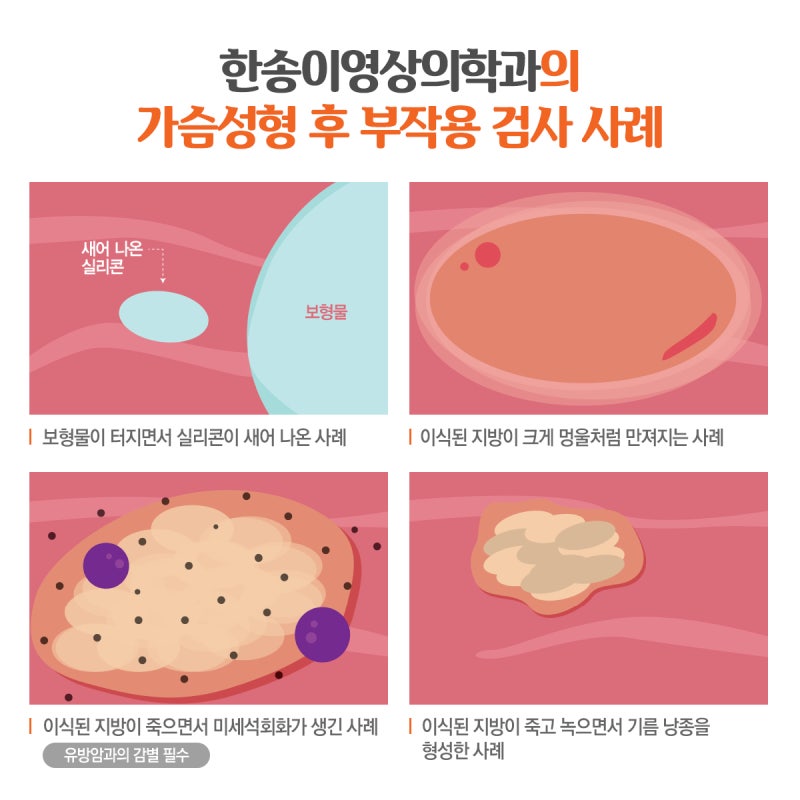 포항가슴성형 초음파 검사가 중요한 3