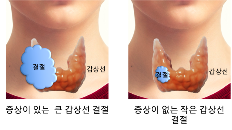 갑상선 결절 형상 갑상선 결절 형상 크기 범위