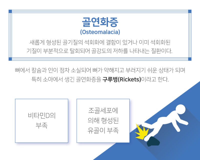 구루병이나 비타민 D 결핍의 경우