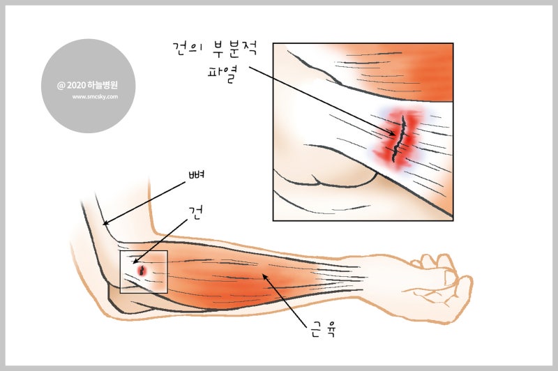 외측상과염 테니스엘보 치료법 염증만 없애면 끝?