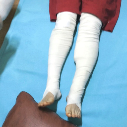  순천 아나파 적맥통증의원 | 하지정맥류 수술 후기 (수술당일 디테일, 후기 추가)