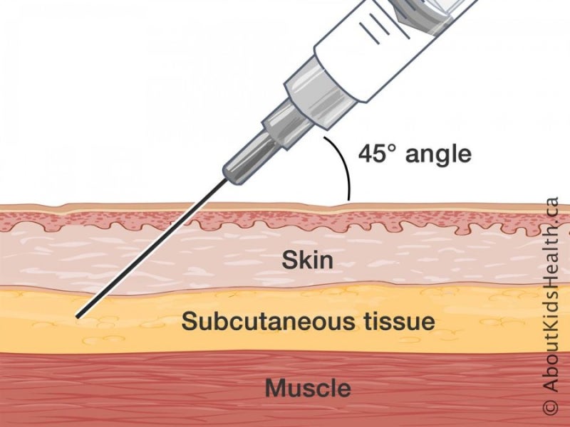 subcutaneous-injection