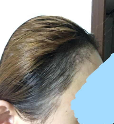 대구헤어라인교정 고민이시라면 리얼테스트로 가보세요 6