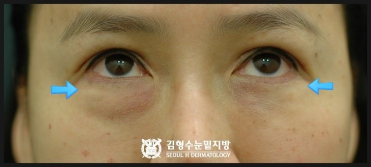 눈밑지방이식 부작용 치료방법 4