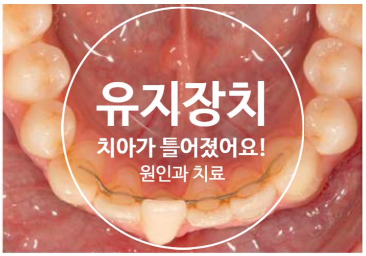 치아교정 유지장치로 치아가 틀어졌다고? (feat. fixed retainer) 유지장치로 인한 치아 틀어짐의 원인과 해경방법 치아교정 유지장치로 치아가 틀어졌다고? (feat. fixed retainer) 유지장치로 인한 치아 틀어짐의 원인과 해경방법