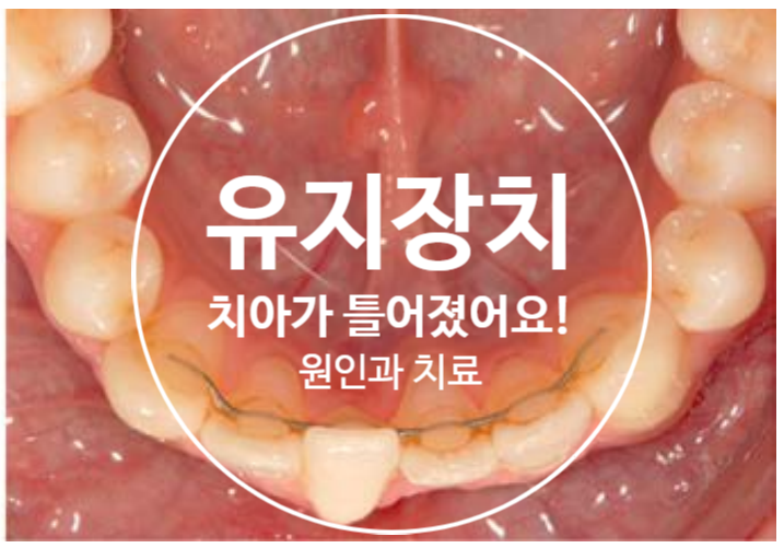 치아교정 유지장치로 치아가 틀어졌다고? (feat. fixed retainer) 유지장치로 인한 치아 틀어짐의 원인과 해경방법