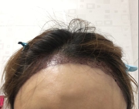 대구헤어라인교정 고민이시라면 리얼테스트로 가보세요 3